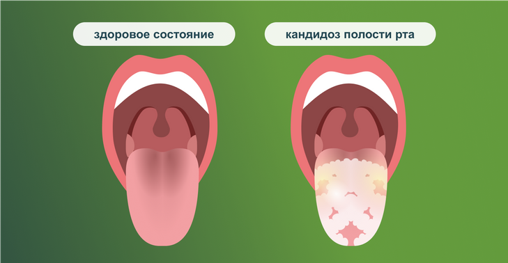 Симптомы кандидоза полости рта.png